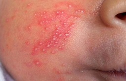 Bệnh Viêm Da Mủ: Nguyên Nhân, Triệu Chứng, Cách Chữa Trị