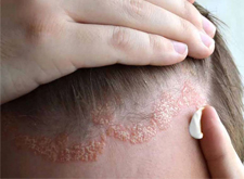 Viêm Da Dầu Ở Đầu Là Bệnh Gì? Triệu Chứng Và Cách Xử Lý