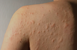 Viêm Da Dị Ứng Tắm Lá Gì? 15 Loại Thảo Dược Bạn Nên Dùng